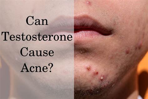 What Causes Acne Testosterone